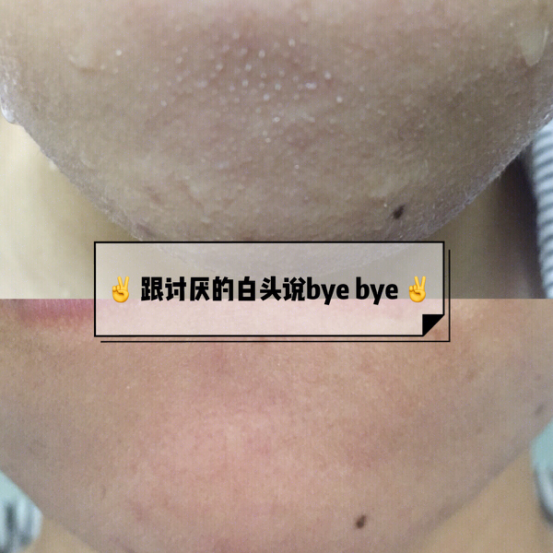 LIFETRONS一招轻松搞定去白头