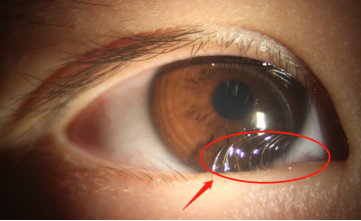 5岁男童眼睫毛“倒着长”专家:这种先天眼病常被家长忽视
