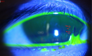 5岁男童眼睫毛“倒着长”专家:这种先天眼病常被家长忽视 母婴健康 第2张 5岁男童眼睫毛“倒着长”专家:这种先天眼病常被家长忽视 母婴健康 第2张