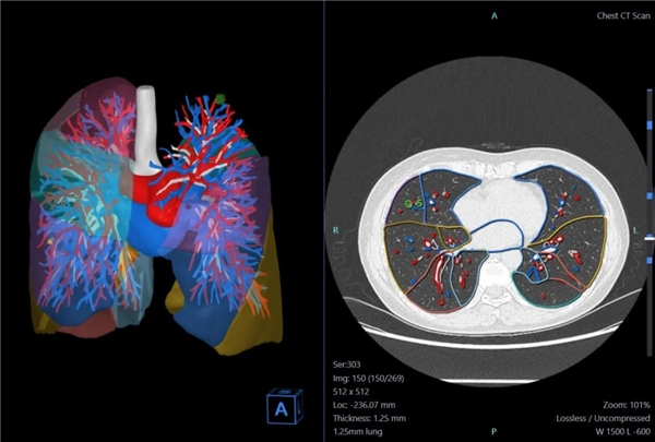 智能医疗时代的GPS | 推想医疗首发AI-4D胸部智能可视化解决方案 新闻资讯 第7张 智能医疗时代的GPS | 推想医疗首发AI-4D胸部智能可视化解决方案 新闻资讯 第7张