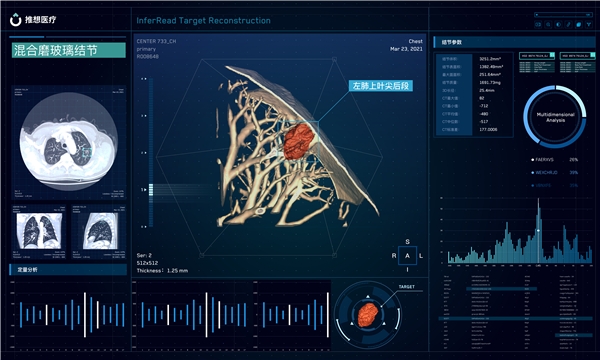 肺结节2.0时代来临:全球首个肺结节AI靶重建产品获NMPA三类证