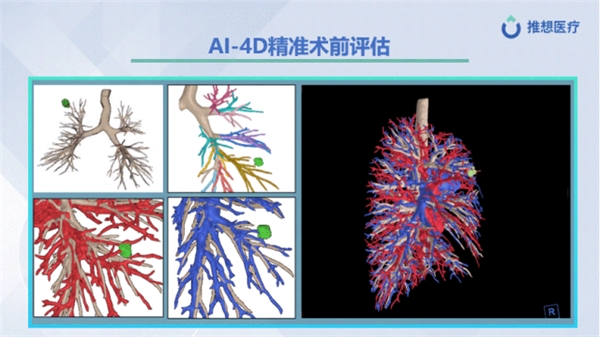 CMEF首日 | 推想全线产品亮相,重磅发布AI-4D平台 新闻资讯 第6张 CMEF首日 | 推想全线产品亮相,重磅发布AI-4D平台 新闻资讯 第6张