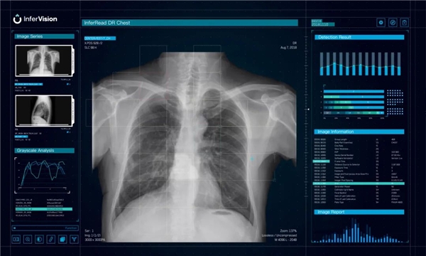 专注肺结核筛查和诊断的MDR CE第一证!推想医疗DR产品获批国际准入 新闻资讯 第4张 专注肺结核筛查和诊断的MDR CE第一证!推想医疗DR产品获批国际准入 新闻资讯 第4张